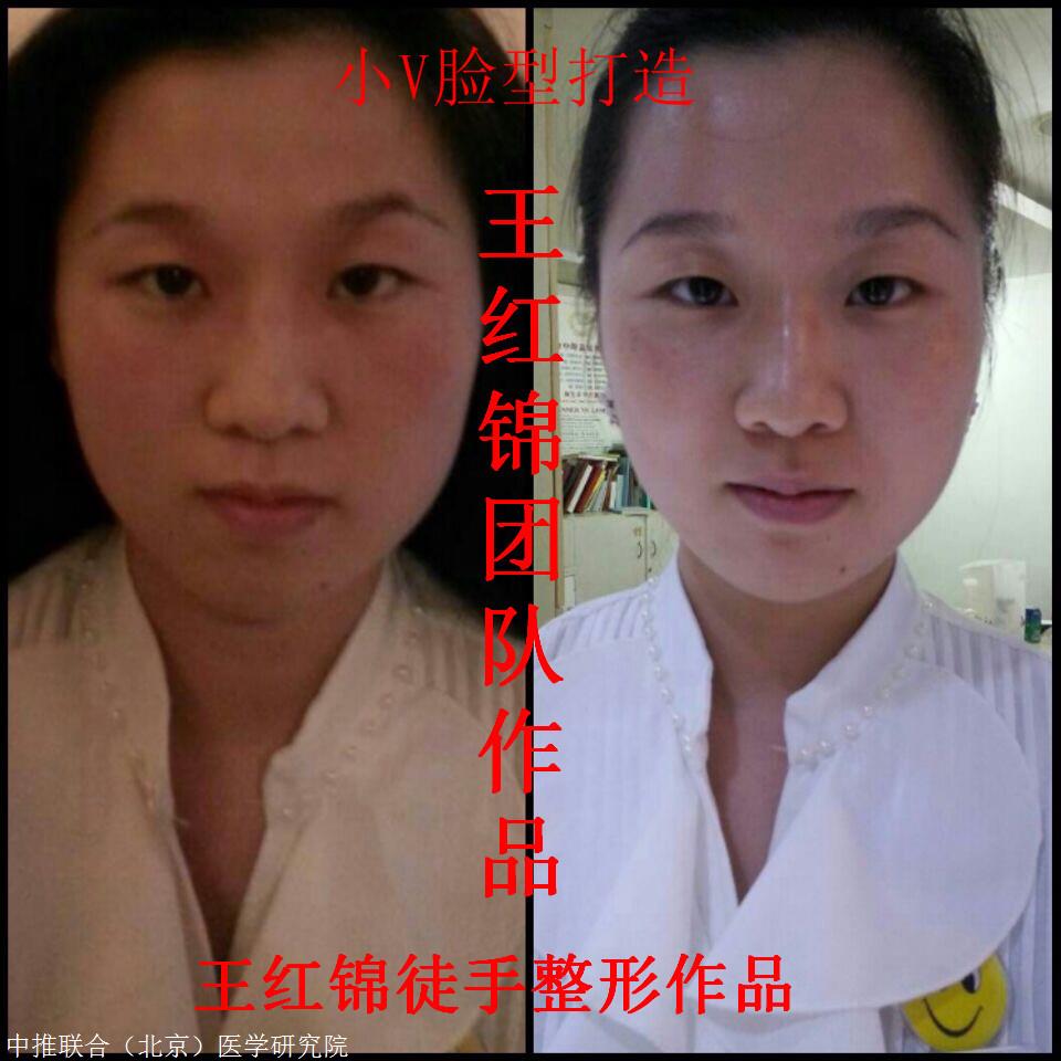 中医针灸培训学校王红锦徒手整形全科班反馈