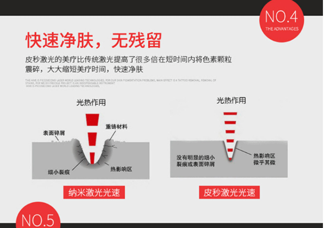 色素激光机祛斑项目治疗过程介绍