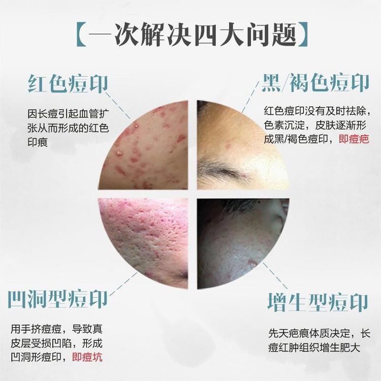 美白祛痘坑痘印产品 oem祛痘霜贴牌生产价格现货批发