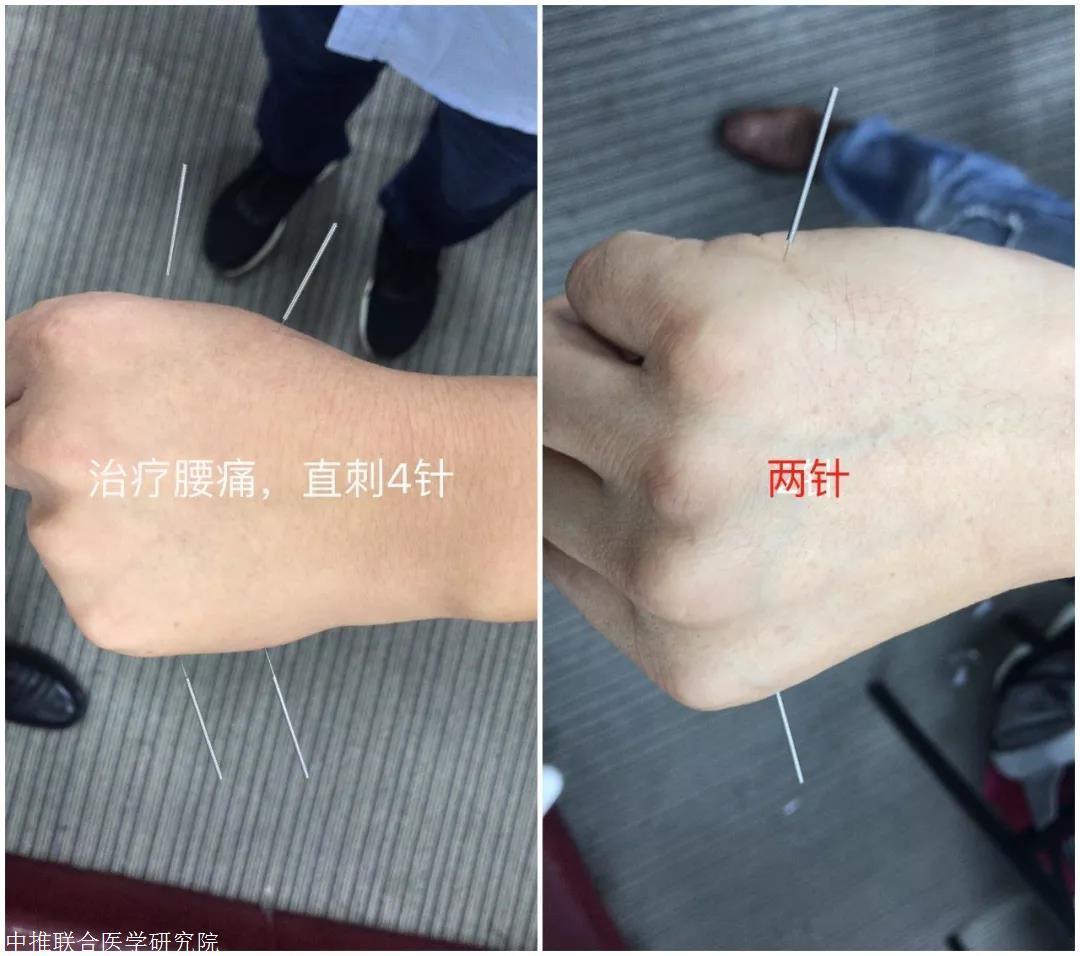 中医针灸培训新一针疗法31种针灸技巧