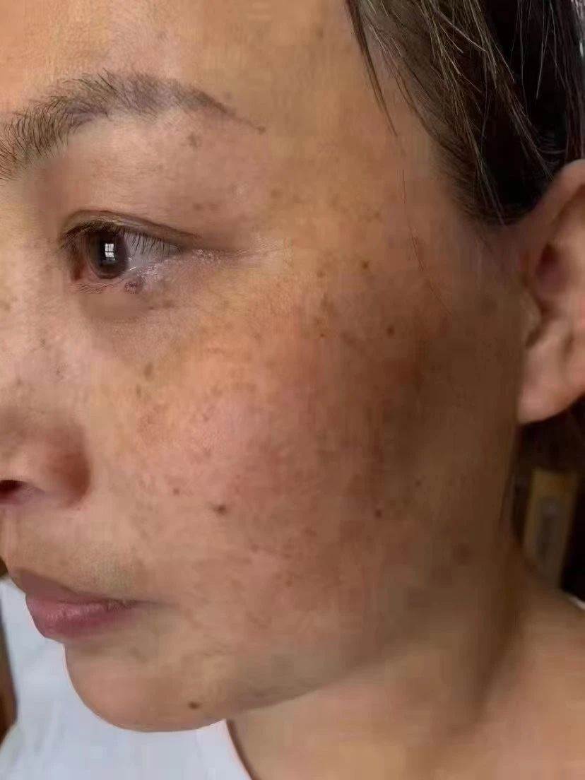 无创溶斑焕白祛斑套盒祛晒斑去活性斑祛斑套盒