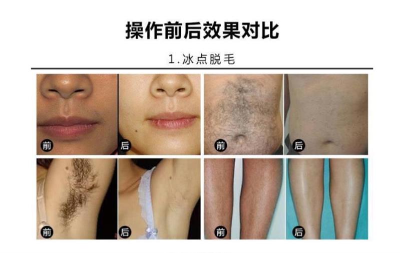 808冰点无痛半导体激光脱毛仪 德国808半导体激光脱毛仪