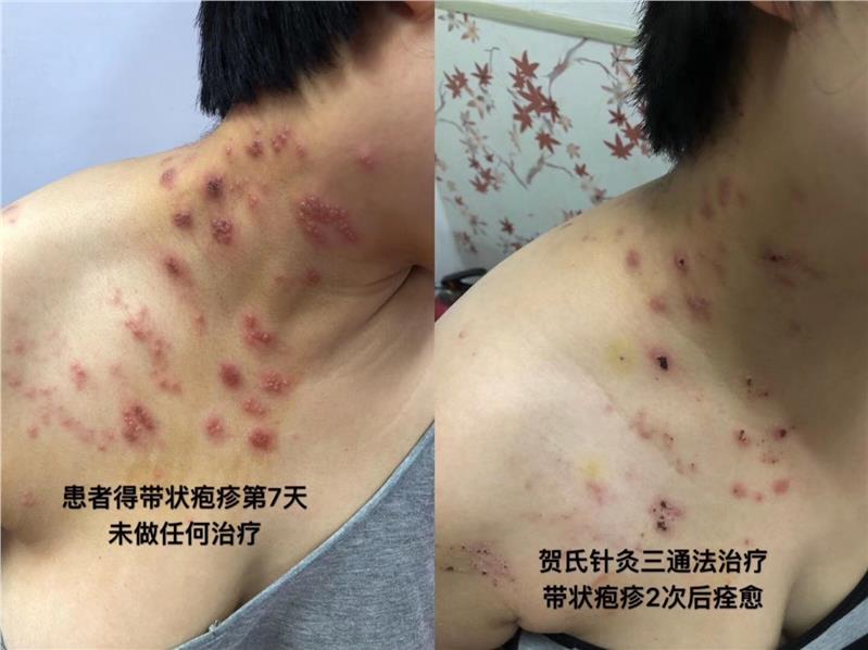 刺络放血培训三亚正规针灸培训班