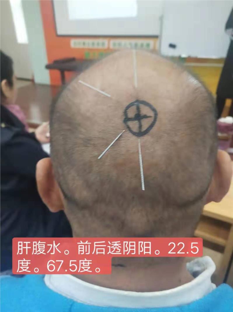 董氏針灸培訓 無錫徐娟絕三針哪裡好