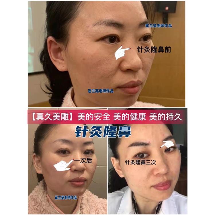 合肥针灸真久美雕效果好