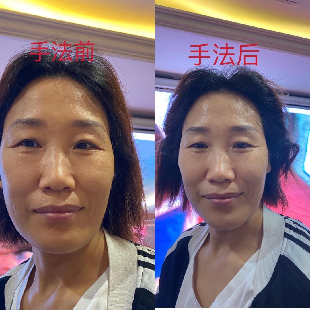 台湾骨盆修复培训班王红锦徒手整形培训班手把手教学