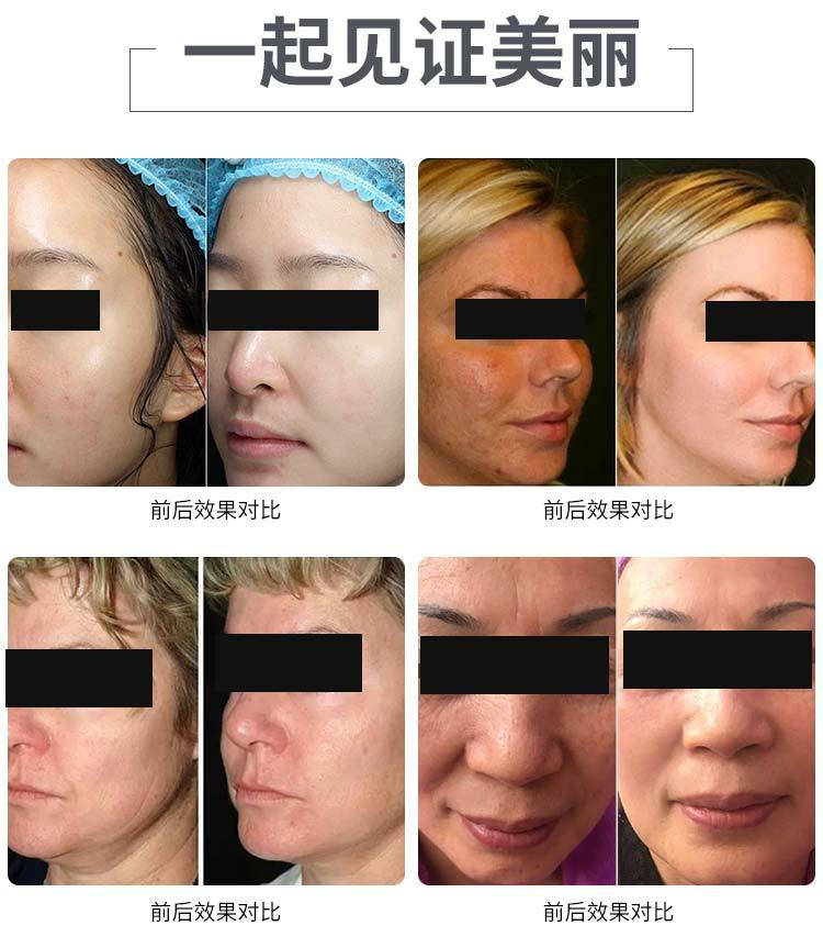 皱纹2,改善肤质肤色1,面部5d年轻化博瑞莱6大功能:轻松舒适:美容过程